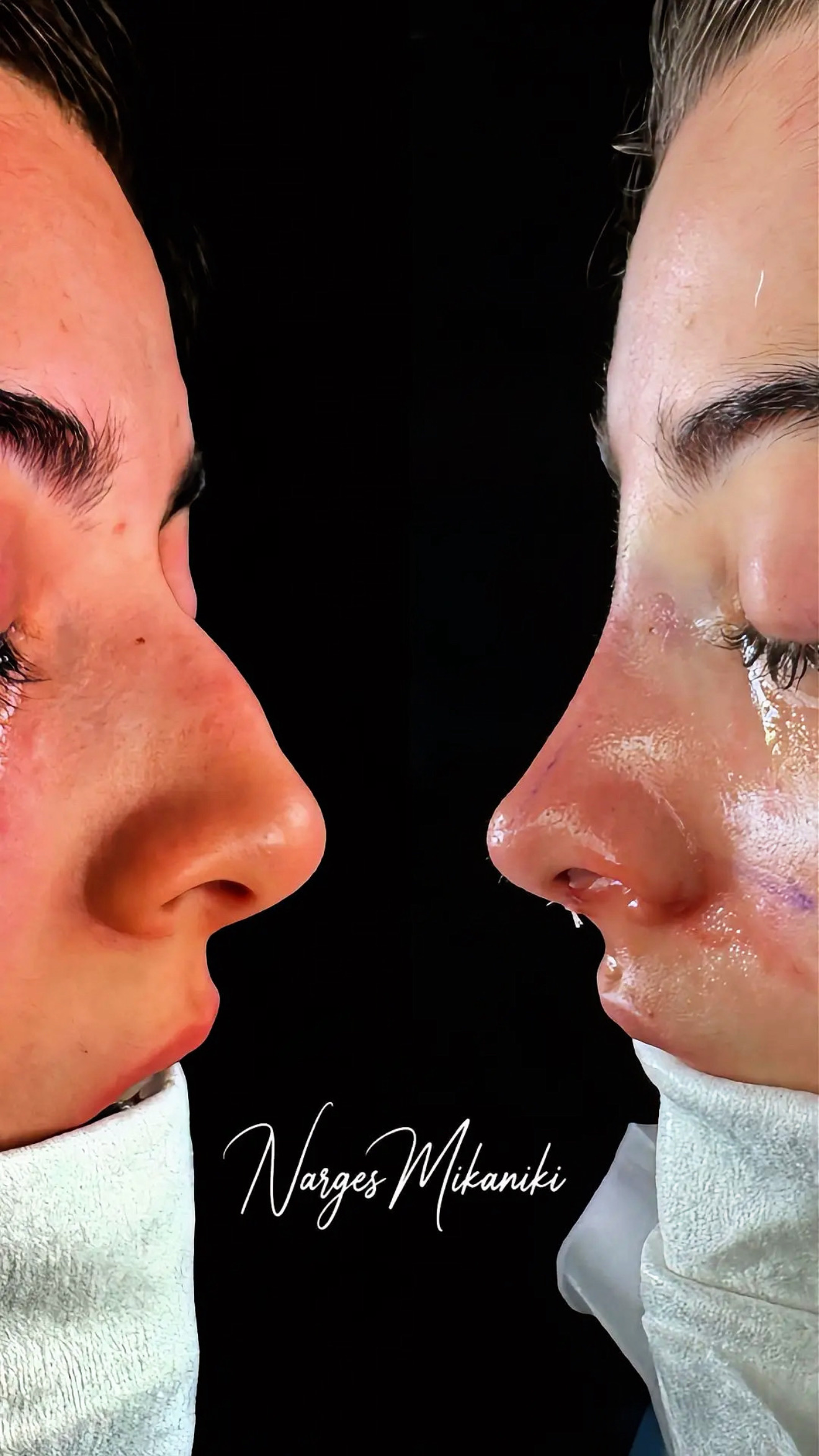Rhinoplasty before and after result, case 1