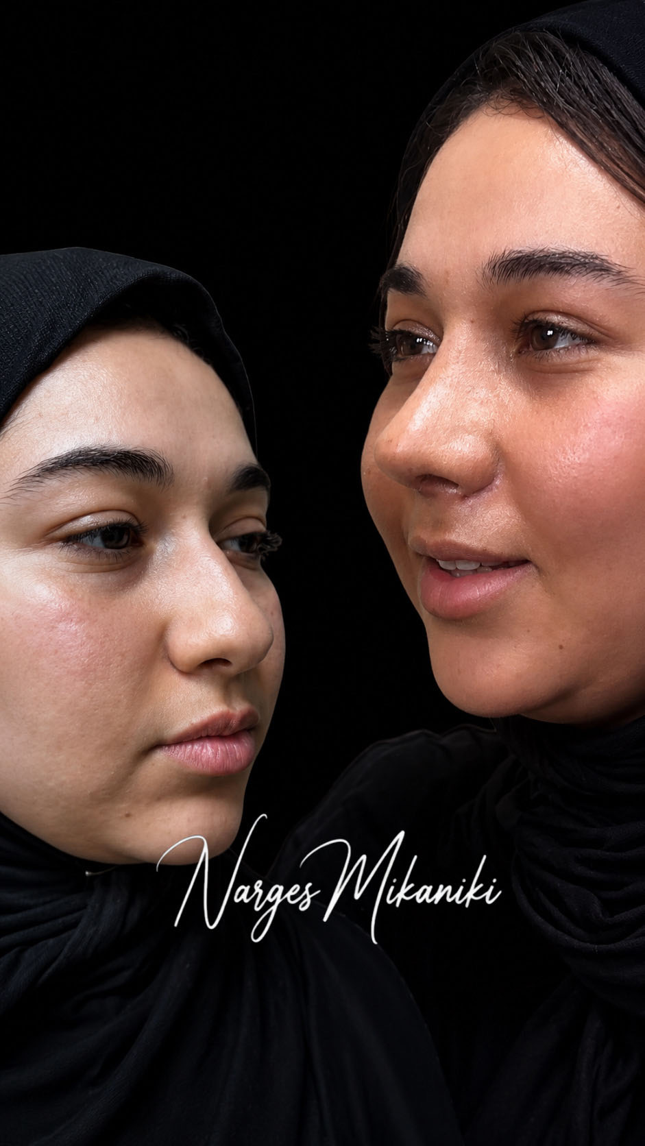 Rhinoplasty before and after result, case 4