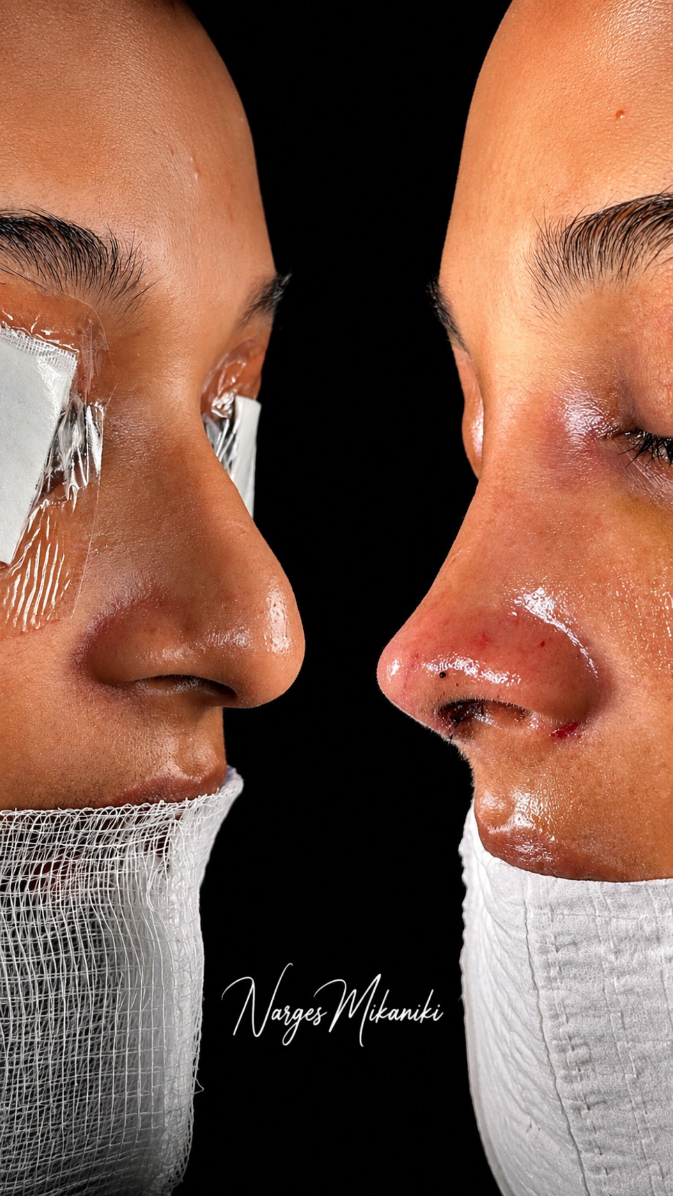 Rhinoplasty before and after result, case 5