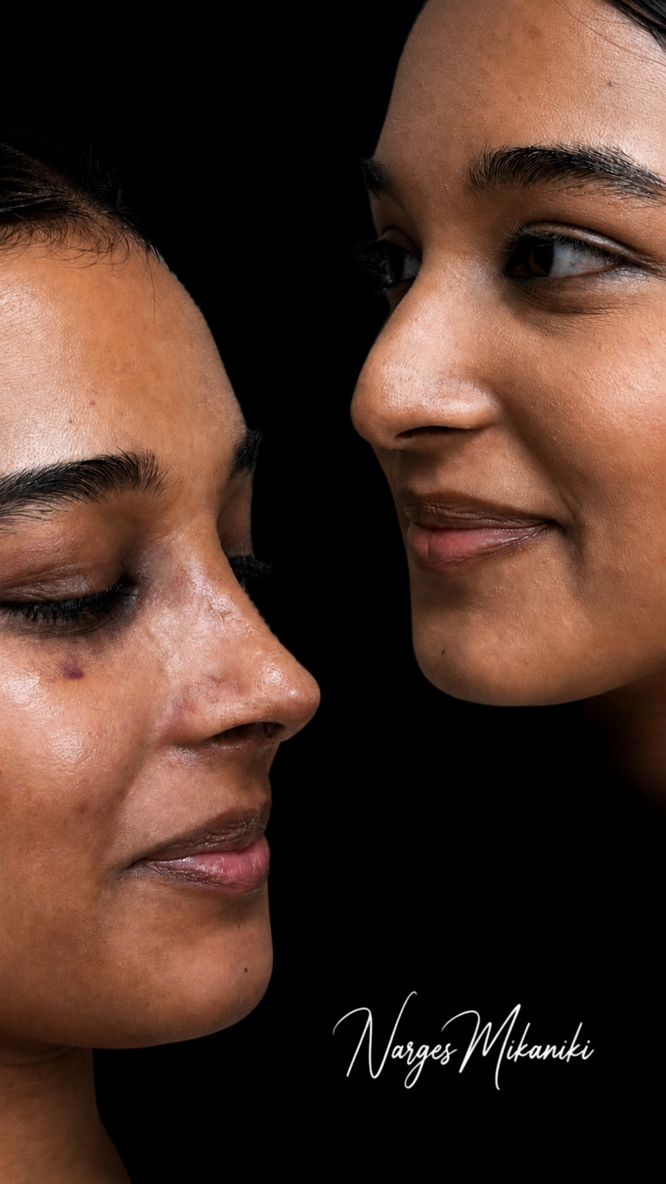 Rhinoplasty before and after result, case 6