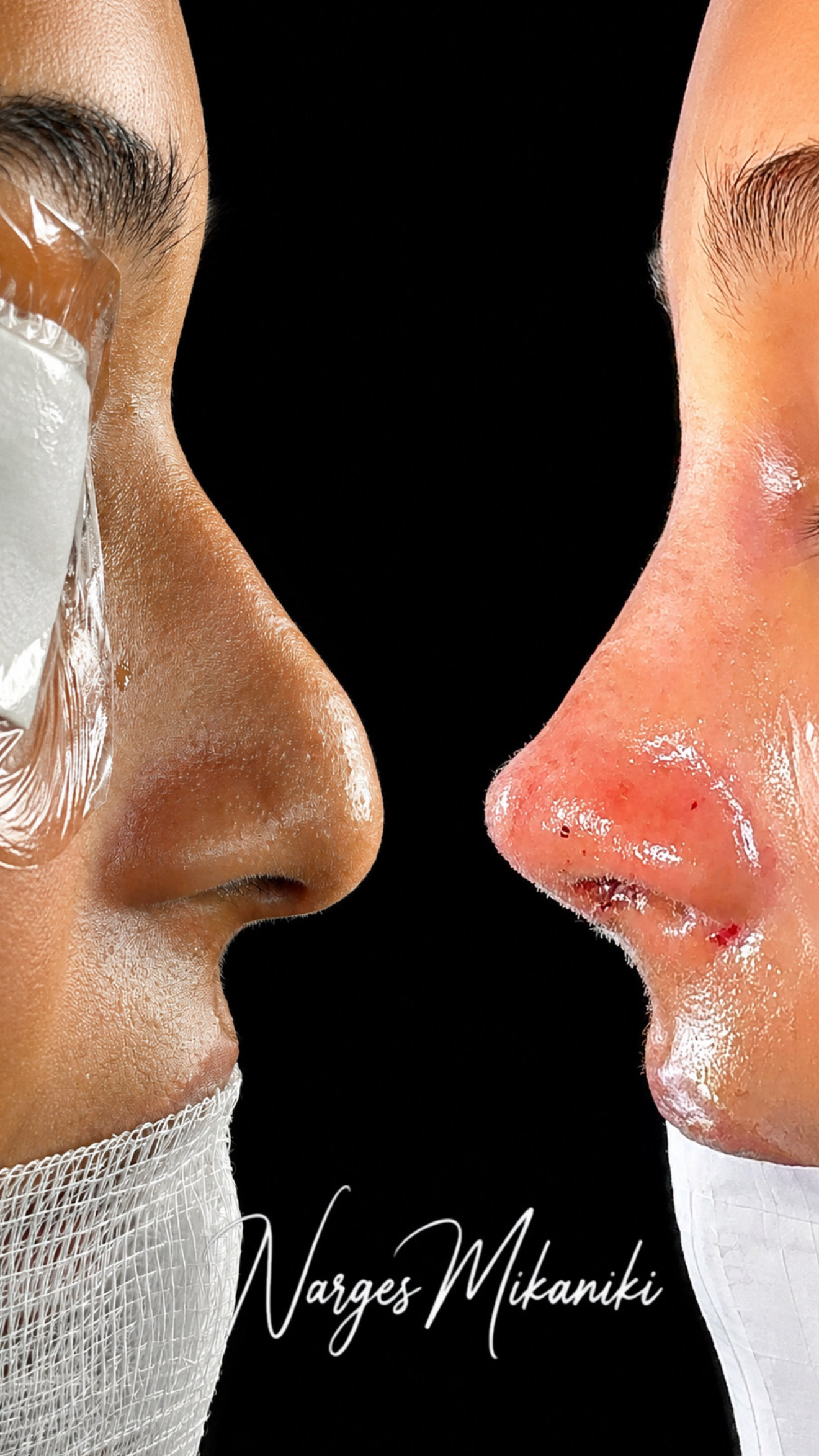 Rhinoplasty before and after result, case 7