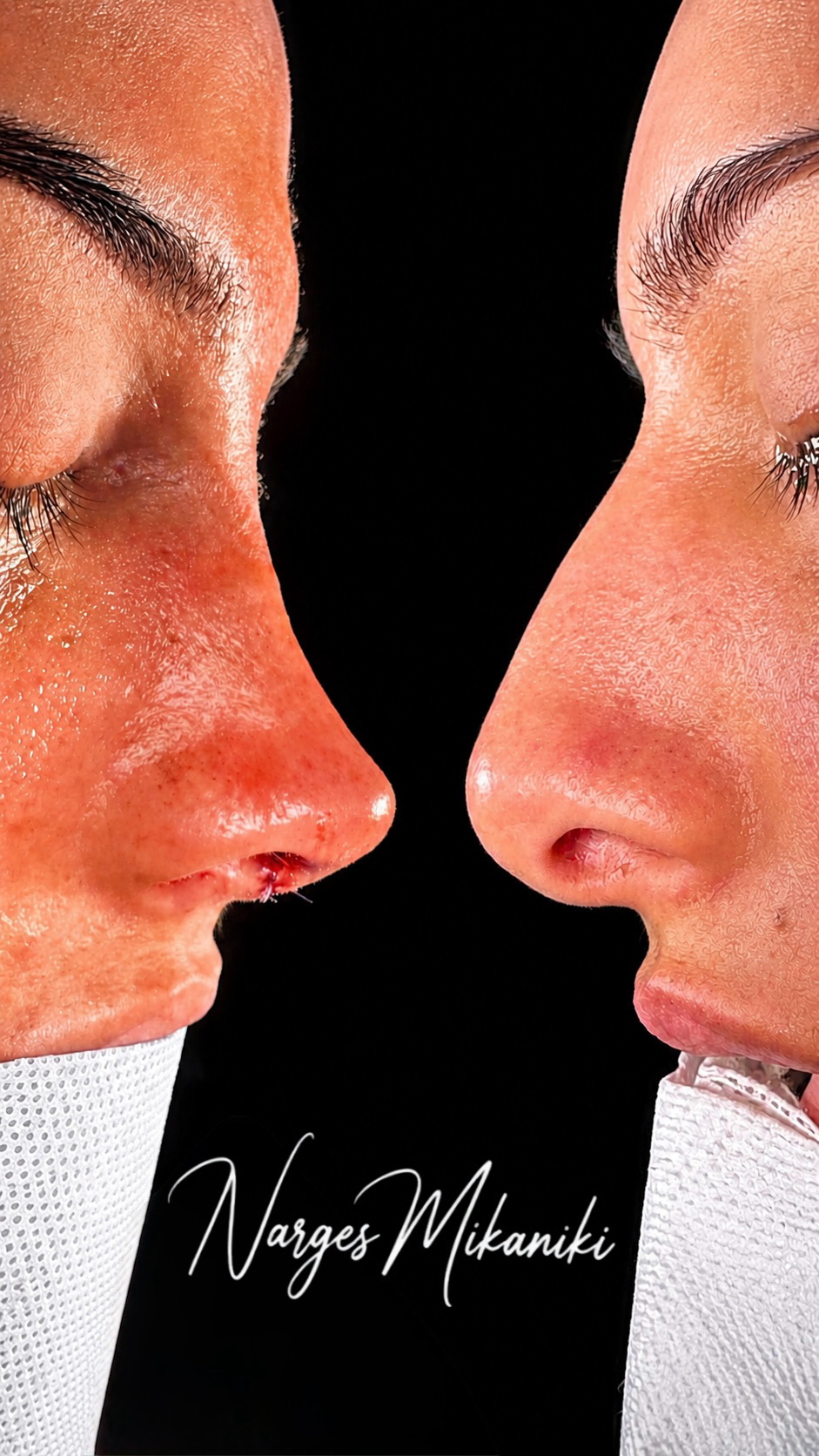 Rhinoplasty before and after result, case 8