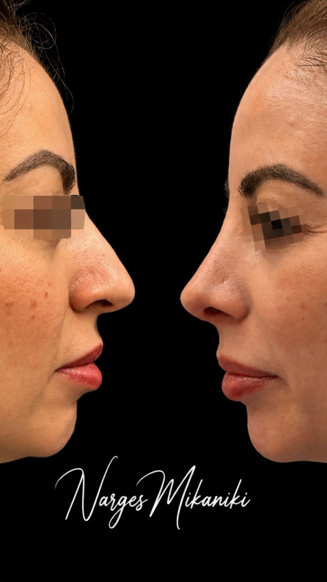 Rhinoplasty before and after result, case 9