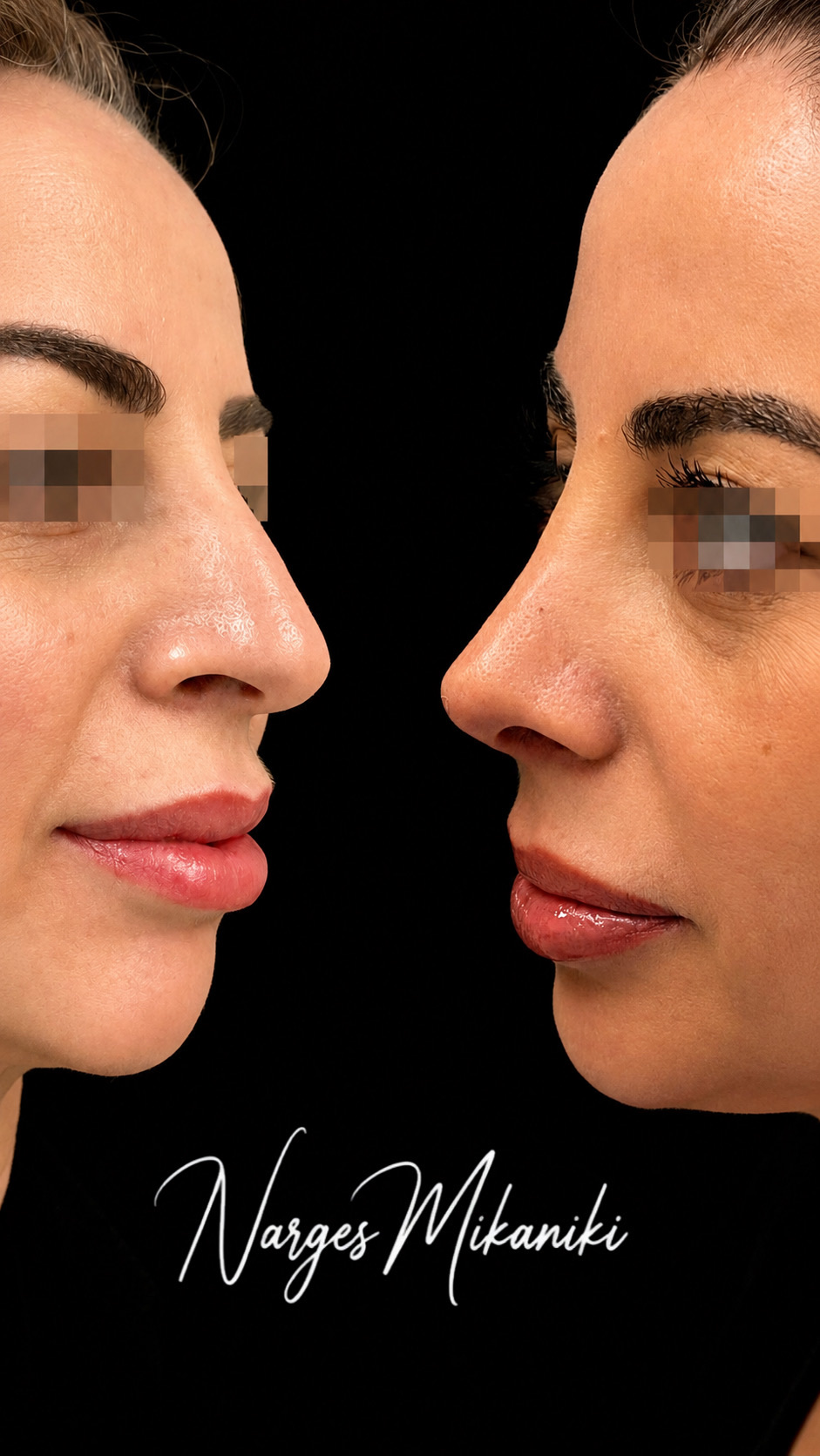 Rhinoplasty before and after result, case 10