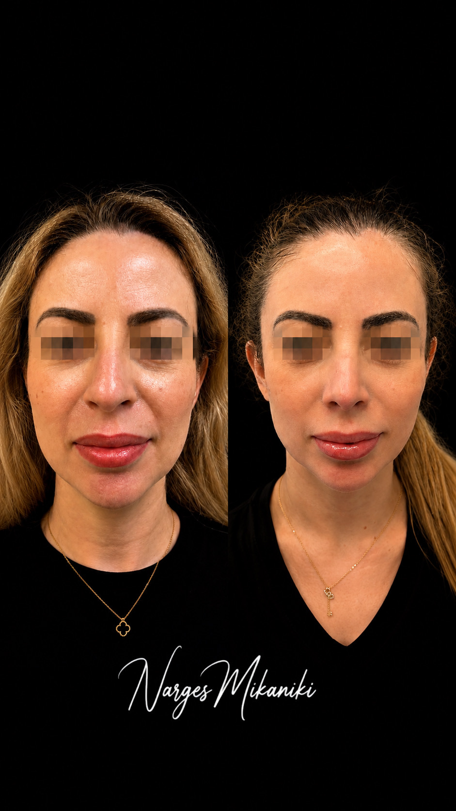 Rhinoplasty before and after result, case 11