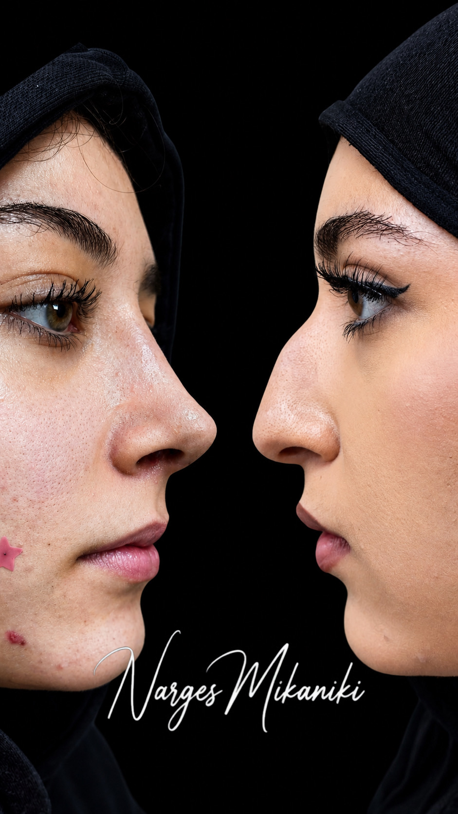 Rhinoplasty before and after result, case 12