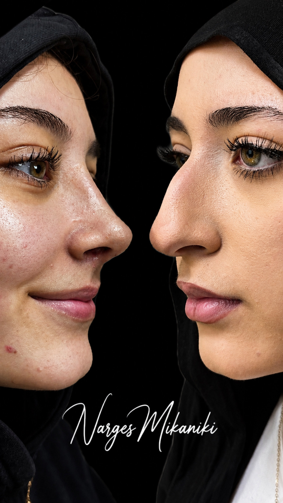 Rhinoplasty before and after result, case 13