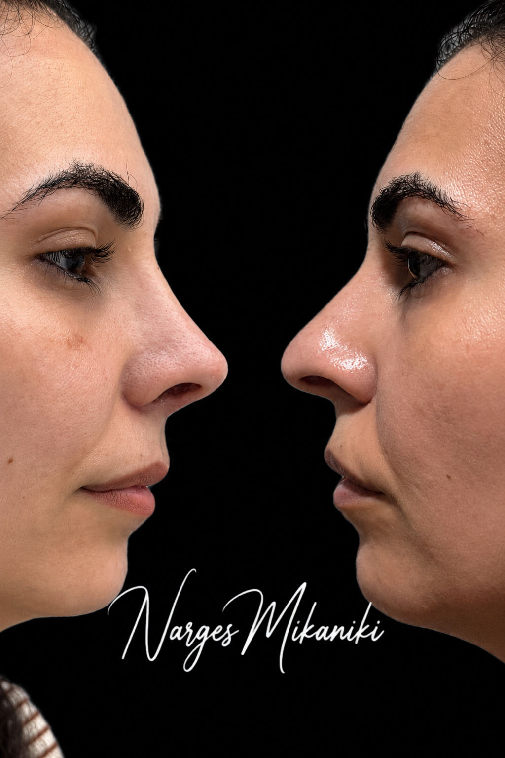 Rhinoplasty before and after result, case 14
