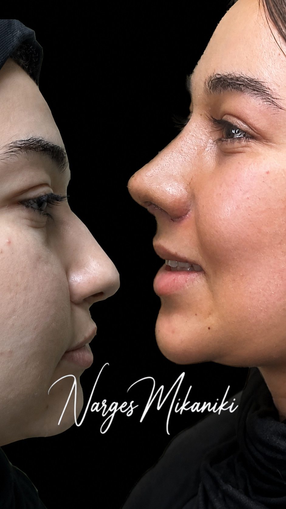 Rhinoplasty before and after result, case 15